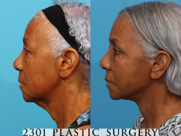 Before & After Face Lift Case 764 Left Side View in Fort Worth, Plano, & Frisco, Texas