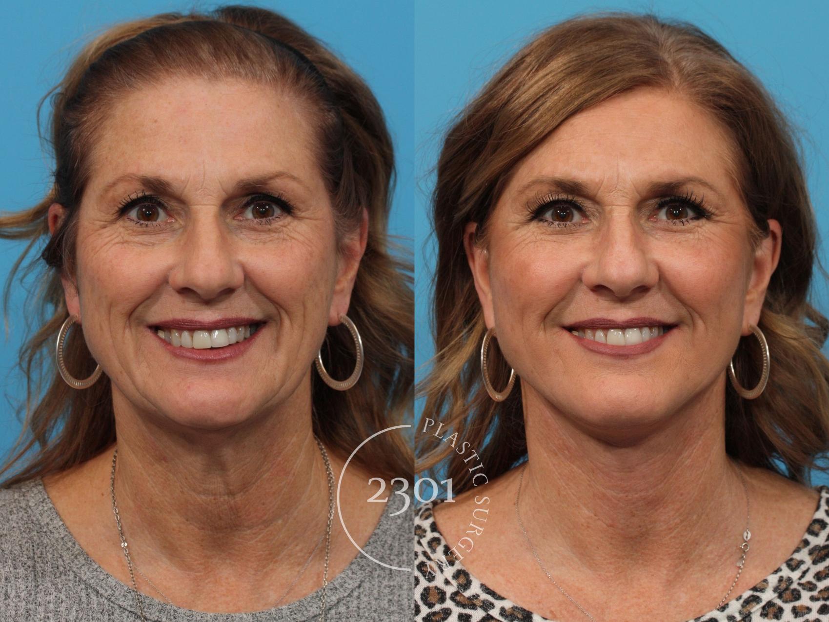 Before & After Face Lift Case 773 Front View in Fort Worth, Plano, & Frisco, Texas