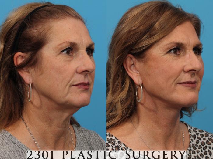 Before & After Neck Lift Case 773 Right Oblique View in Fort Worth, Plano, & Frisco, Texas