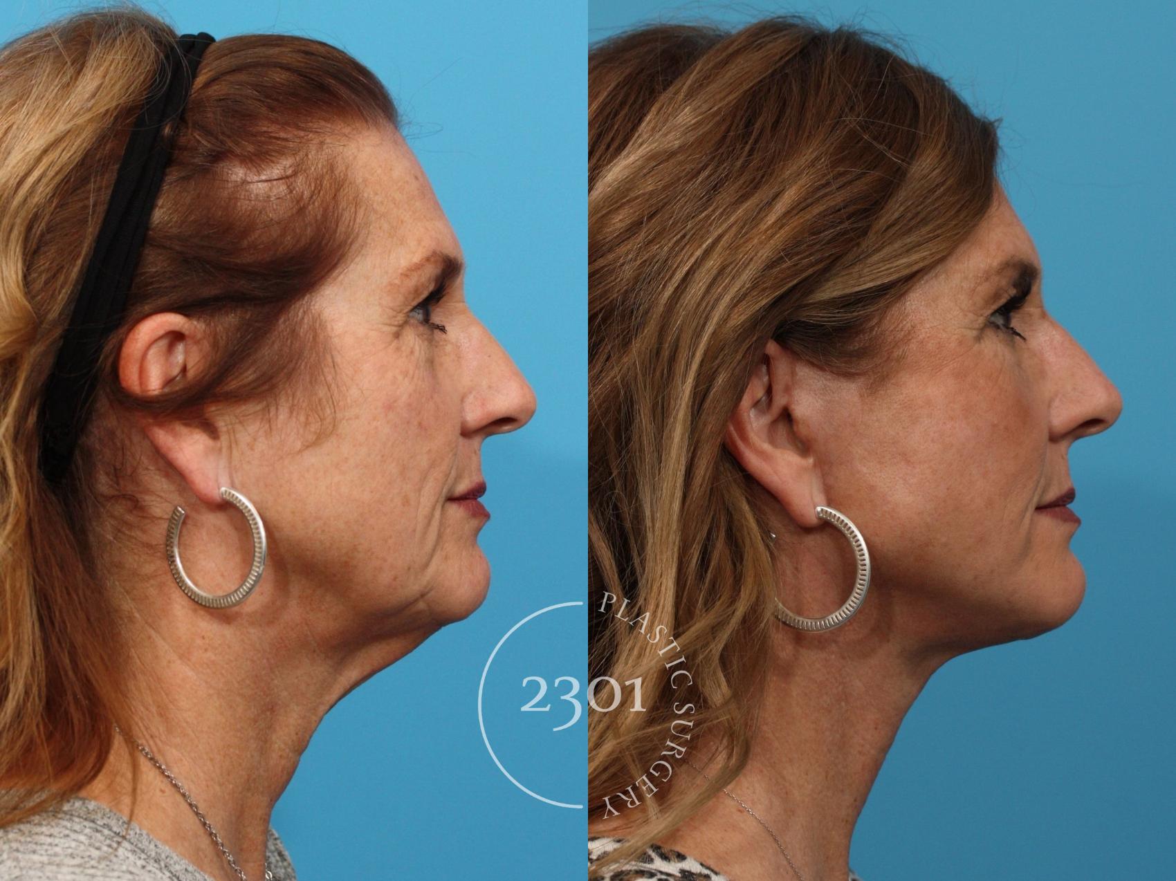 Before & After Face Lift Case 773 Right Side View in Fort Worth, Plano, & Frisco, Texas