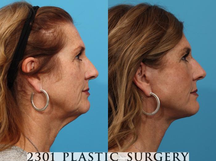 Before & After Face Lift Case 773 Right Side View in Fort Worth, Plano, & Frisco, Texas