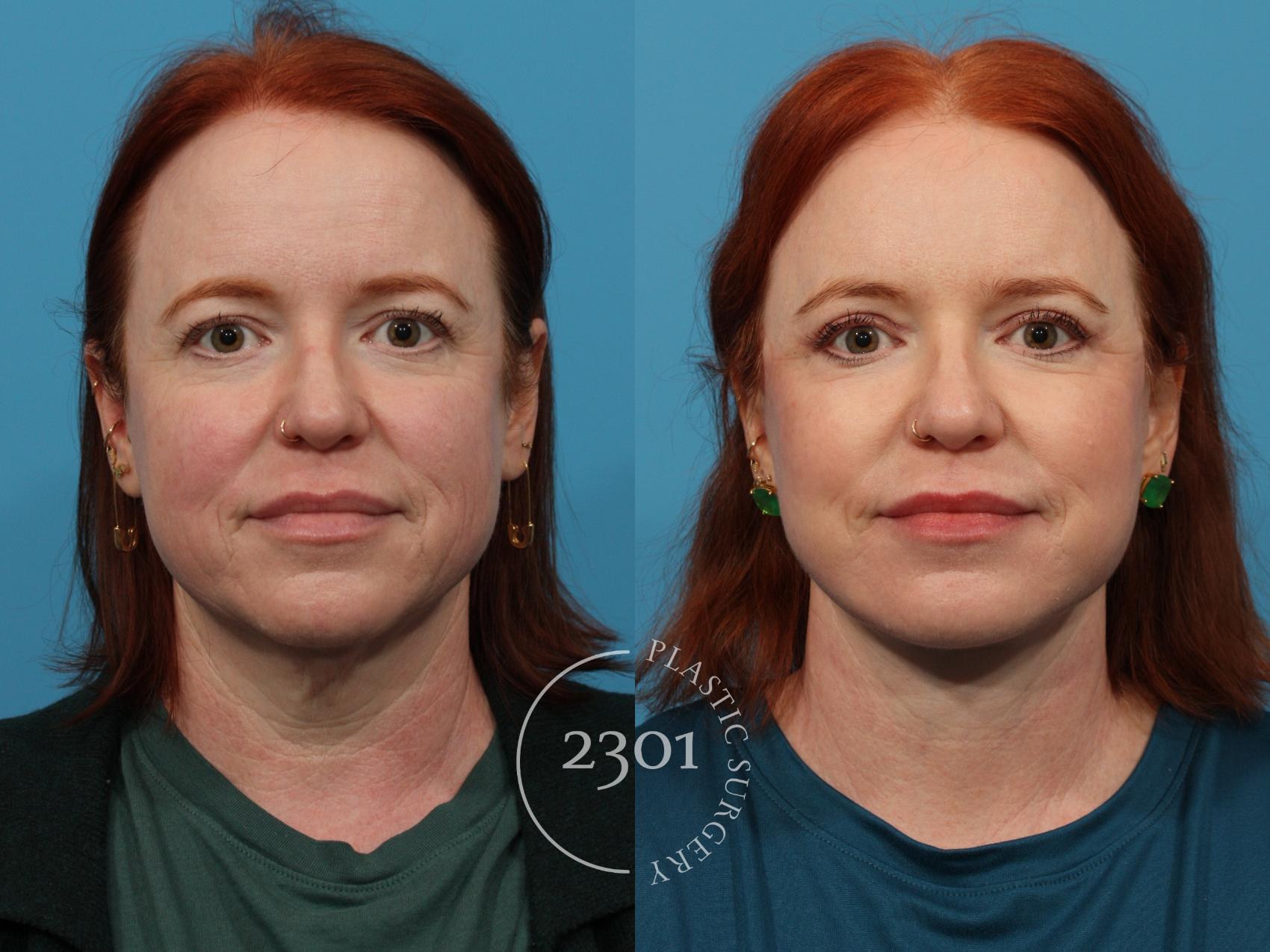 Before & After Blepharoplasty Case 774 Front View in Fort Worth, Plano, & Frisco, Texas