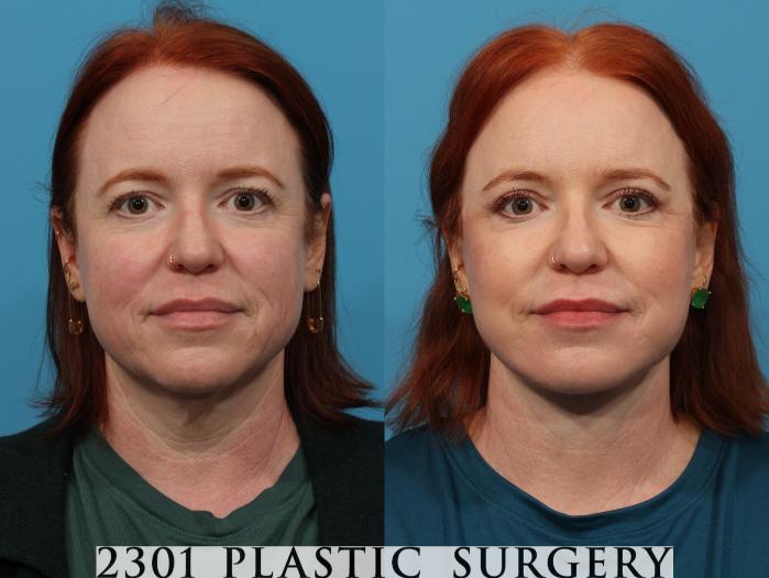 Before & After Neck Lift Case 774 Front View in Fort Worth, Plano, & Frisco, Texas