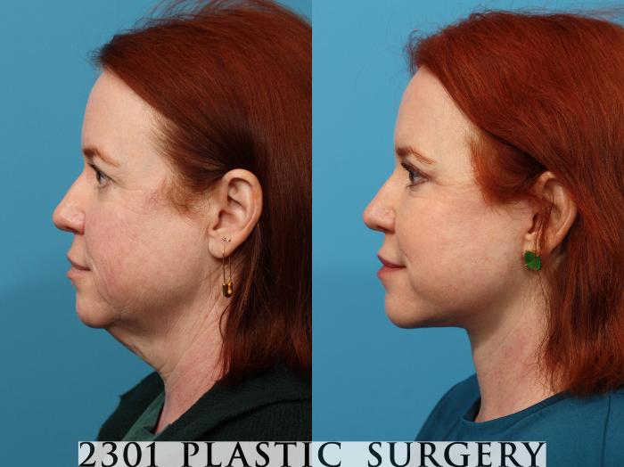 Before & After Neck Lift Case 774 Left Side View in Fort Worth, Plano, & Frisco, Texas