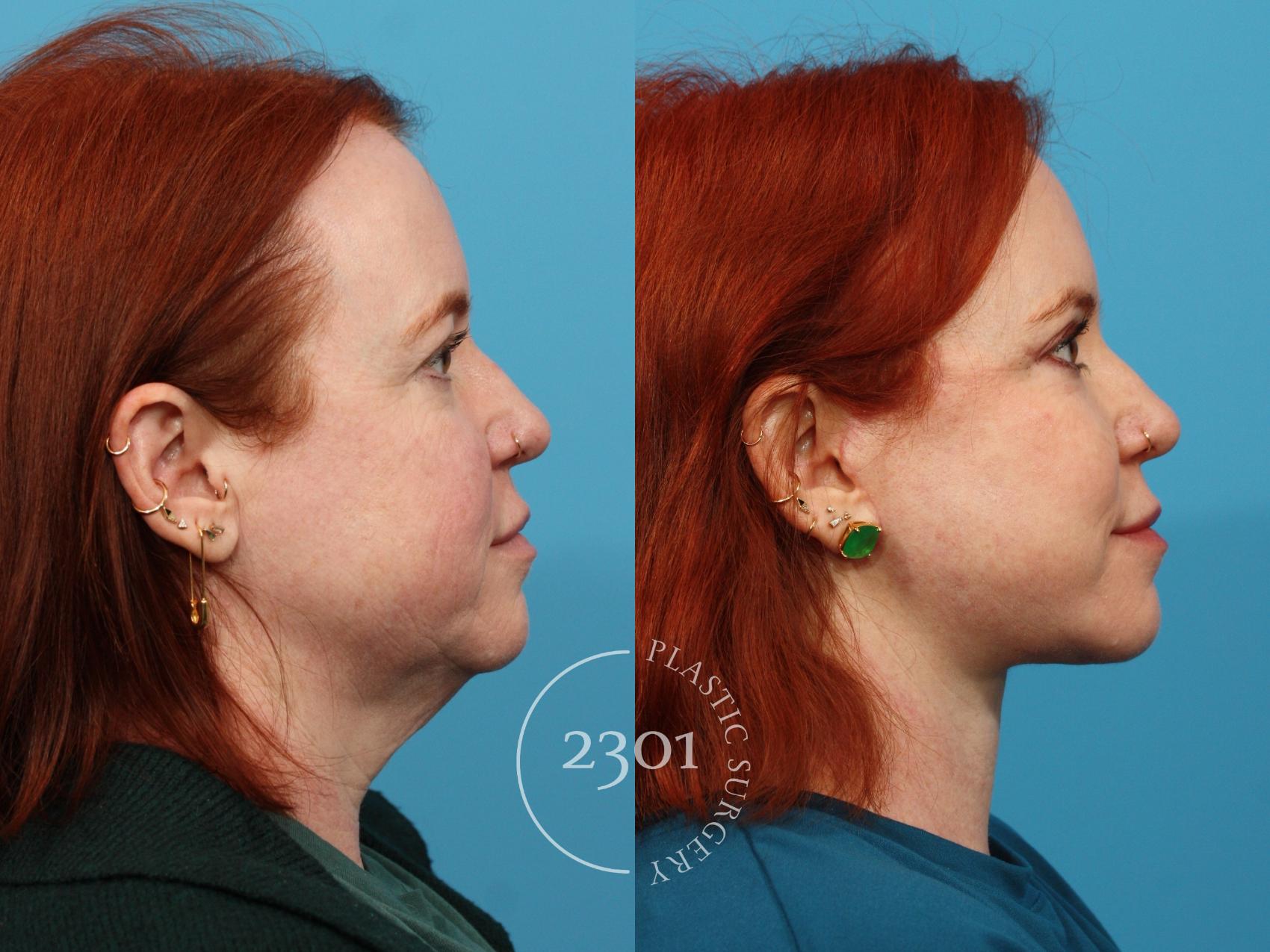 Before & After Blepharoplasty Case 774 Right Side View in Fort Worth, Plano, & Frisco, Texas
