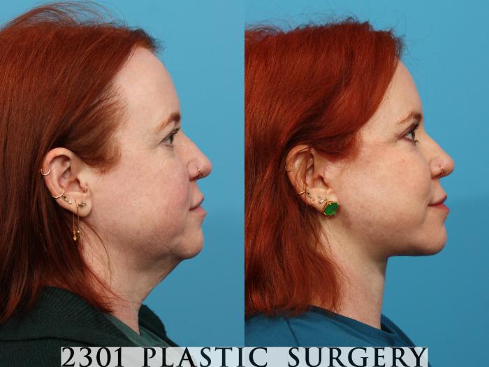 Before & After Blepharoplasty Case 774 Right Side View in Fort Worth, Plano, & Frisco, Texas