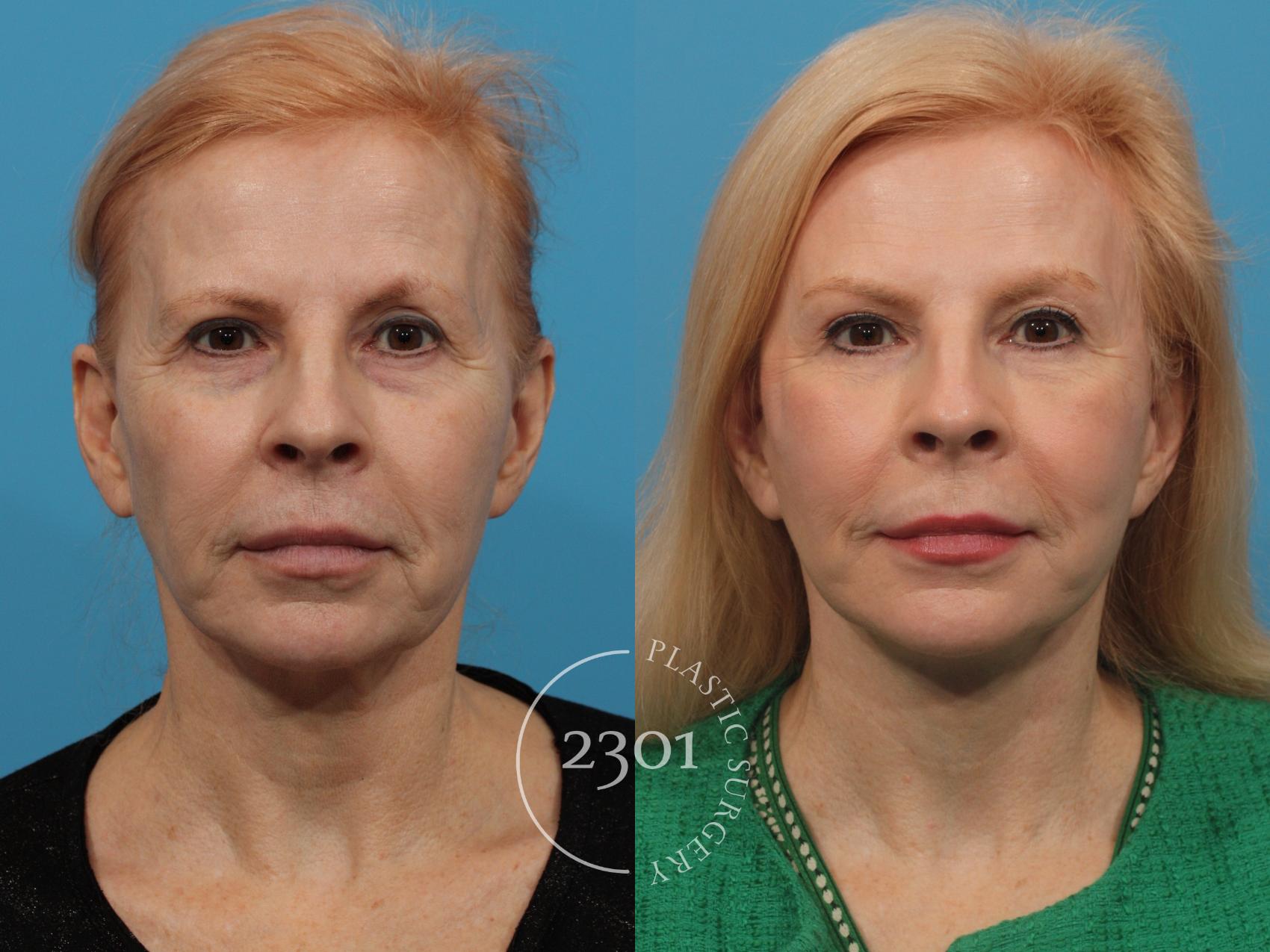 Before & After Blepharoplasty Case 775 Front View in Fort Worth, Plano, & Frisco, Texas