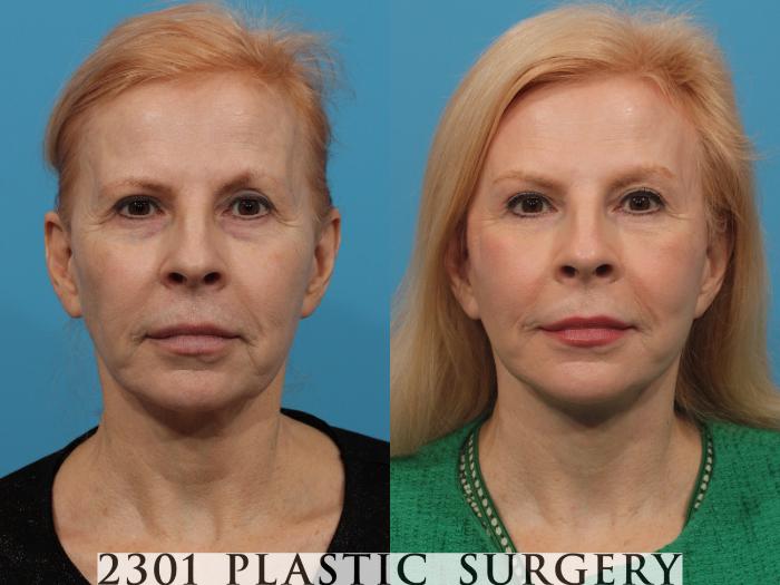 Before & After Brow Lift Case 775 Front View in Fort Worth, Plano, & Frisco, Texas