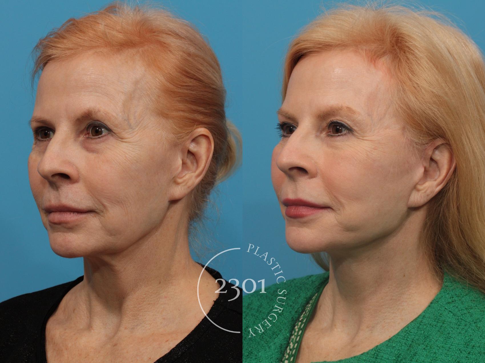 Before & After Face Lift Case 775 Left Oblique View in Fort Worth, Plano, & Frisco, Texas