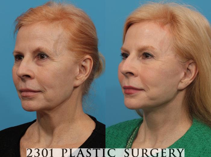 Before & After Blepharoplasty Case 775 Left Oblique View in Fort Worth, Plano, & Frisco, Texas
