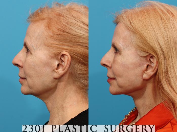 Before & After Face Lift Case 775 Left Side View in Fort Worth, Plano, & Frisco, Texas