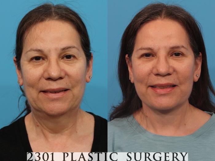 Before & After Face Lift Case 787 Front View in Fort Worth, Plano, & Frisco, Texas