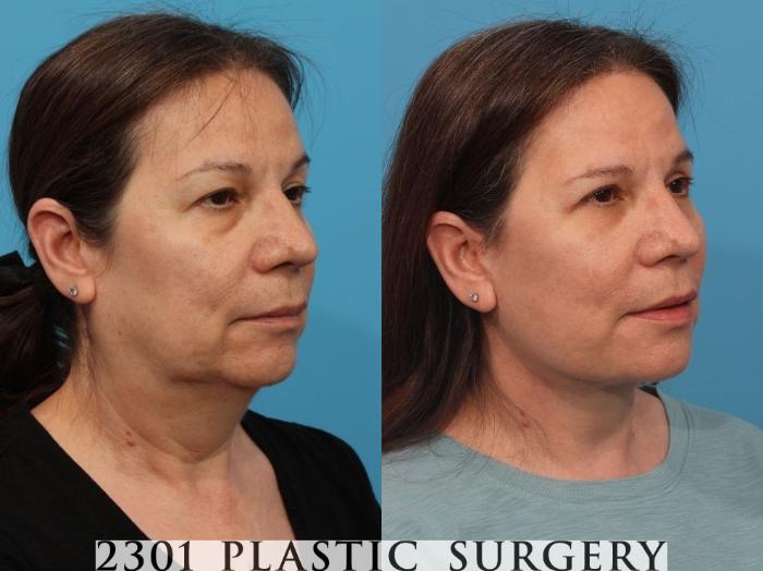 Before & After Facial Fat Grafting Case 787 Left Oblique View in Fort Worth, Plano, & Frisco, Texas