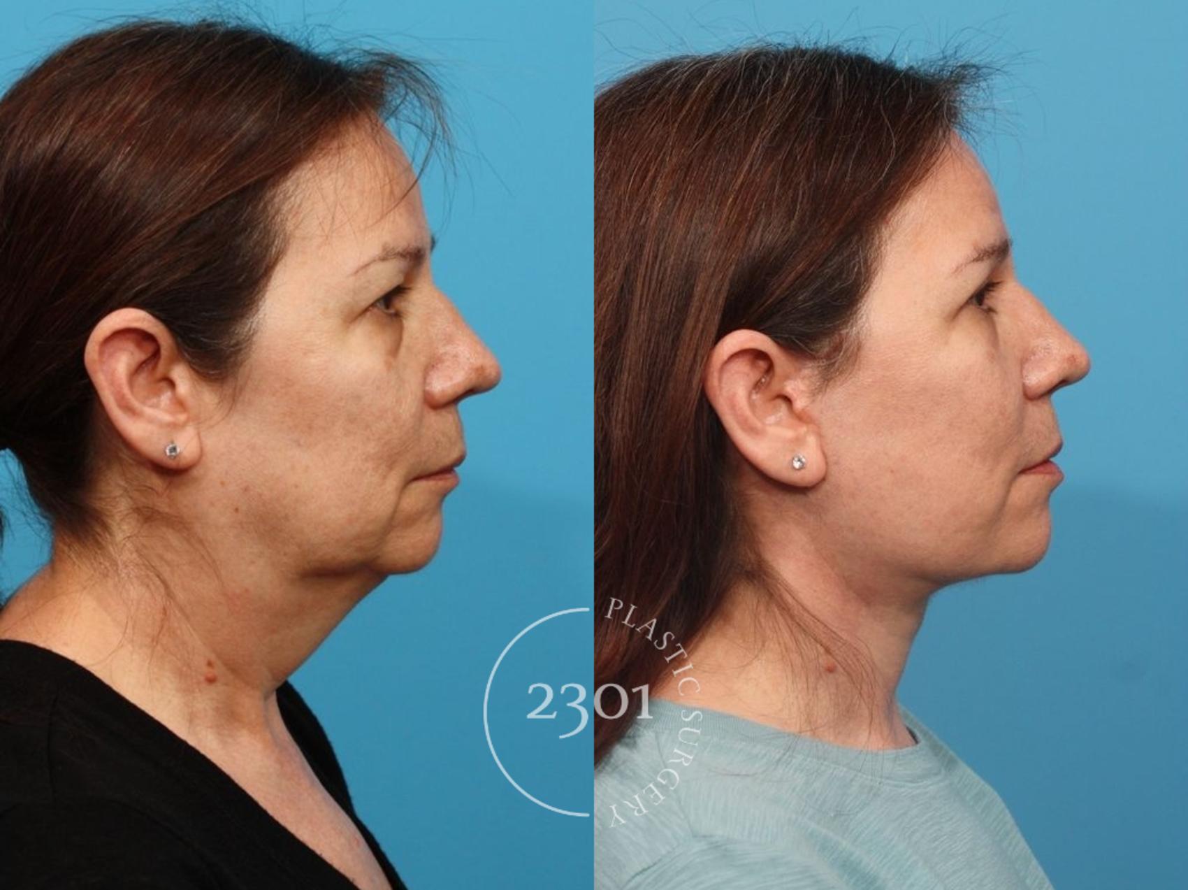 Before & After Facial Fat Grafting Case 787 Left Side View in Fort Worth, Plano, & Frisco, Texas