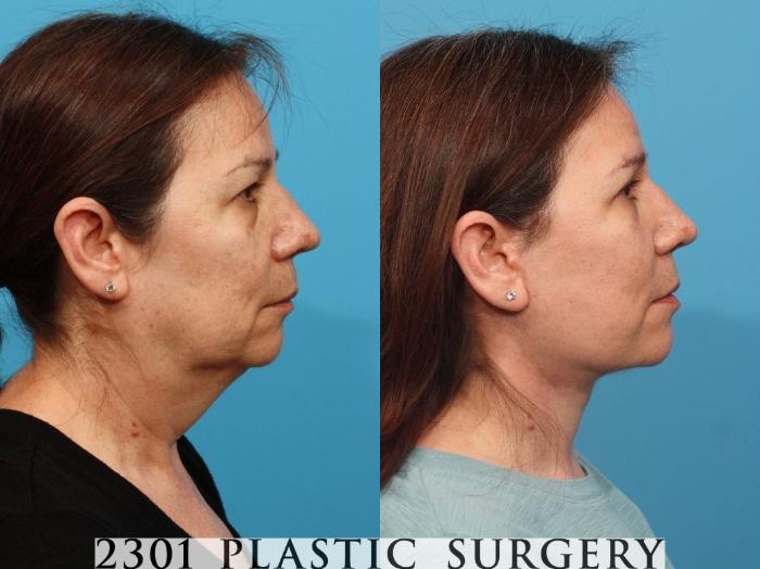 Before & After Face Lift Case 787 Left Side View in Fort Worth, Plano, & Frisco, Texas