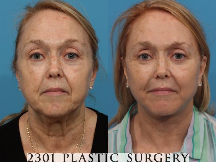 Before & After Face Lift Case 794 Front View in Fort Worth, Plano, & Frisco, Texas