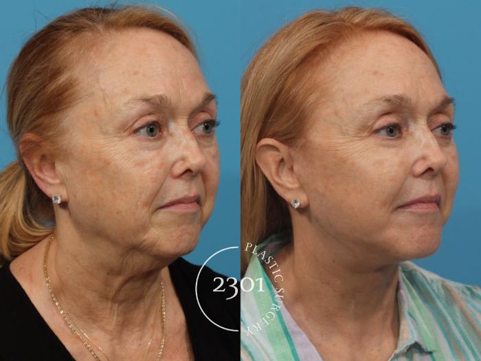 Before & After Face Lift Case 794 Right Oblique View in Fort Worth, Plano, & Frisco, Texas