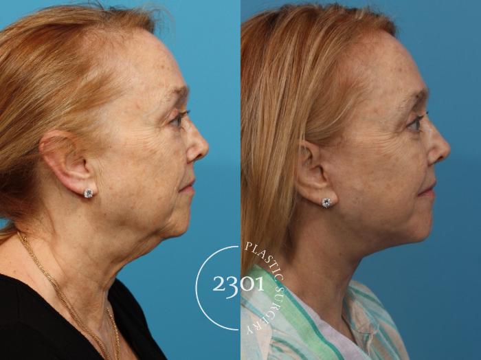 Before & After Face Lift Case 794 Right Side View in Fort Worth, Plano, & Frisco, Texas