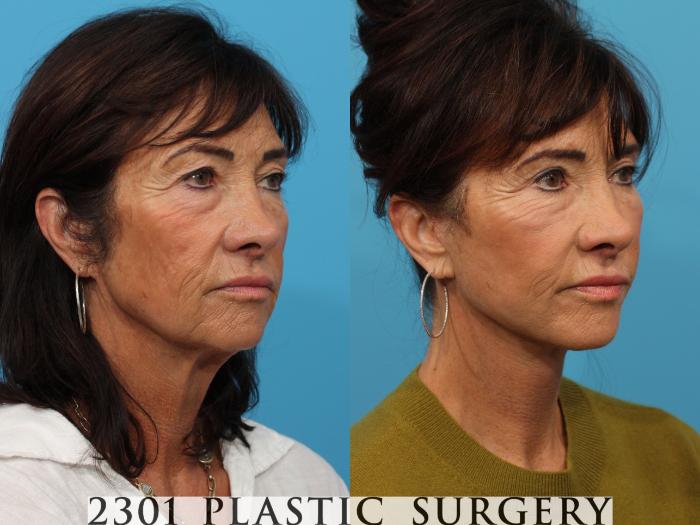 Before & After Face Lift Case 797 Right Oblique View in Fort Worth, Plano, & Frisco, Texas