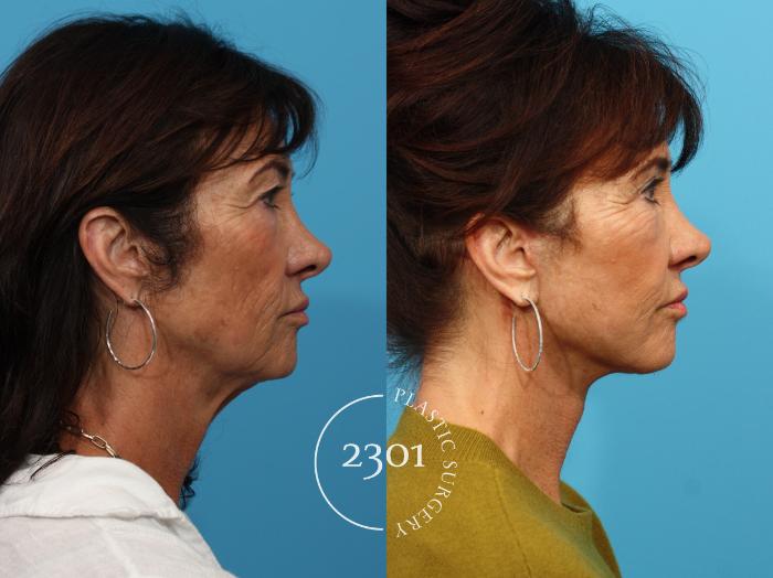 Before & After Face Lift Case 797 Right Side View in Fort Worth, Plano, & Frisco, Texas