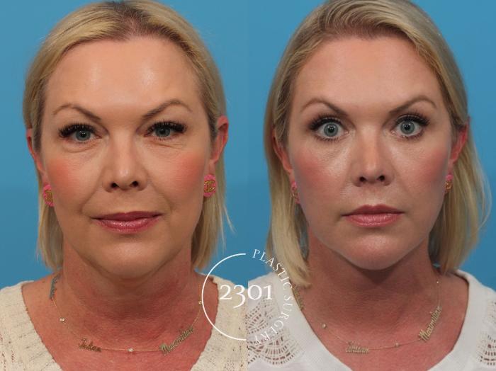 Before & After Blepharoplasty Case 808 Front View in Fort Worth, Plano, & Frisco, Texas