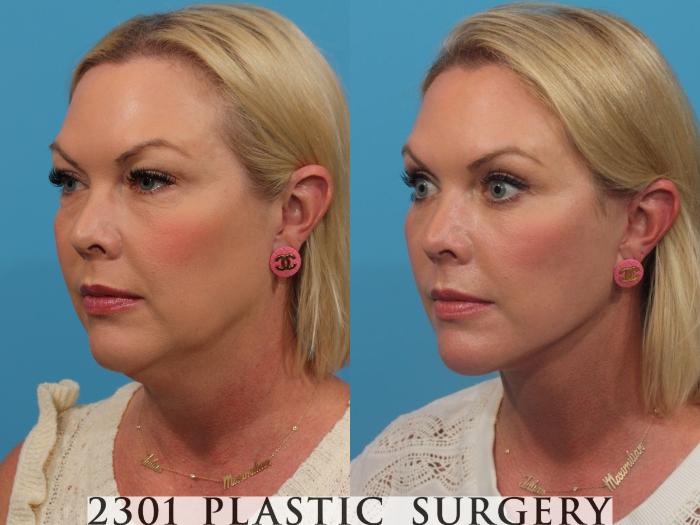 Before & After Neck Lift Case 808 Left Oblique View in Fort Worth, Plano, & Frisco, Texas