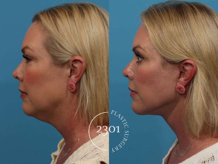 Before & After Neck Lift Case 808 Left Side View in Fort Worth, Plano, & Frisco, Texas