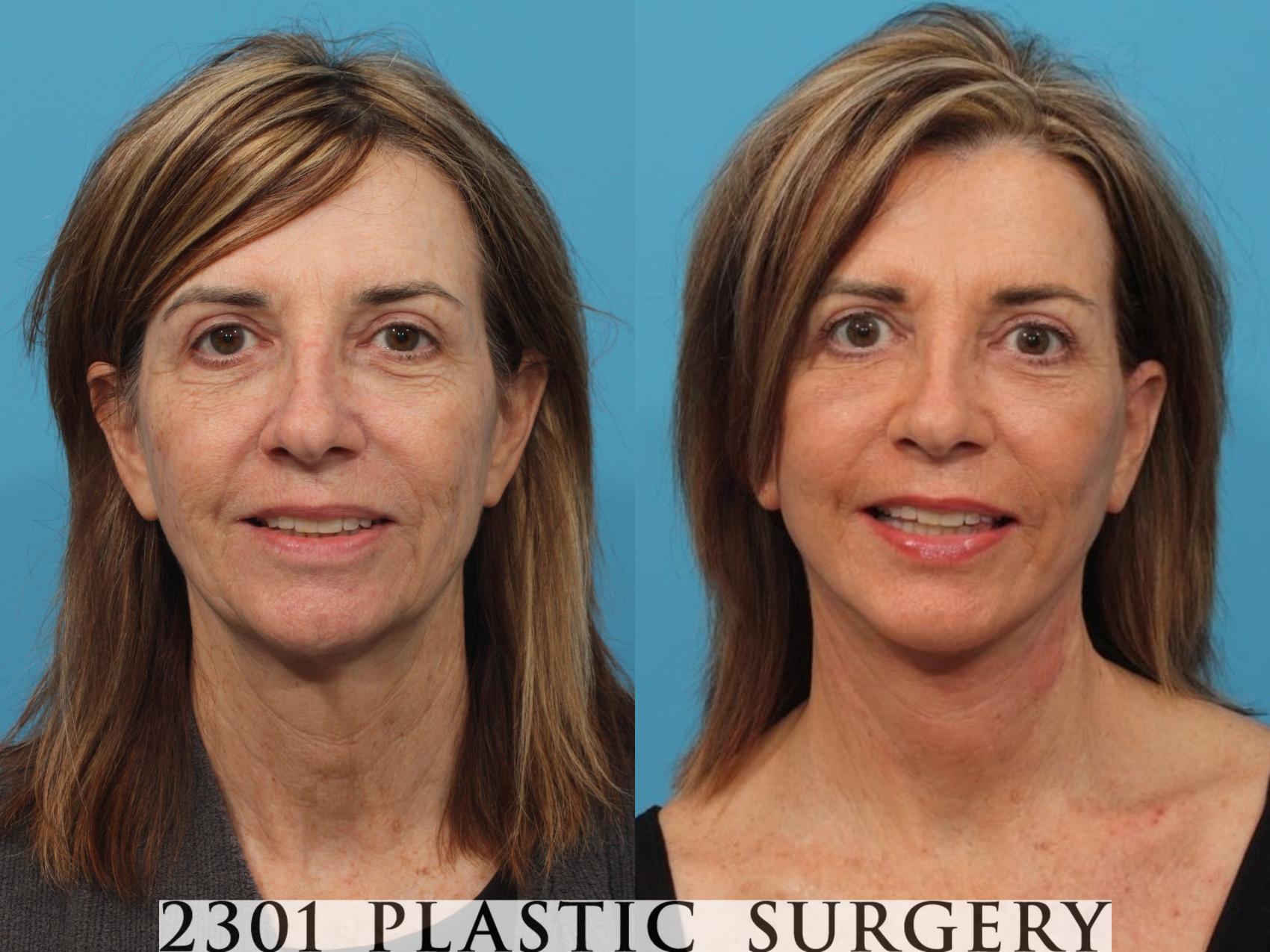Before & After Face Lift Case 819 Front View in Fort Worth, Plano, & Frisco, Texas