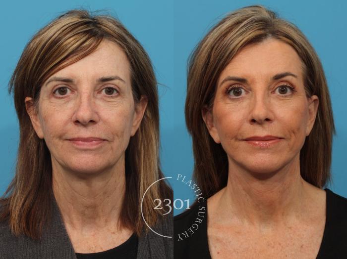 Before & After Face Lift Case 819 Front View in Fort Worth, Plano, & Frisco, Texas