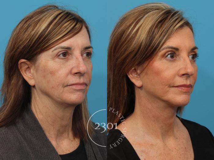 Before & After Face Lift Case 819 Right Oblique View in Fort Worth, Plano, & Frisco, Texas