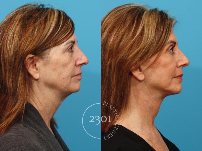 Before & After Face Lift Case 819 Right Side View in Fort Worth, Plano, & Frisco, Texas