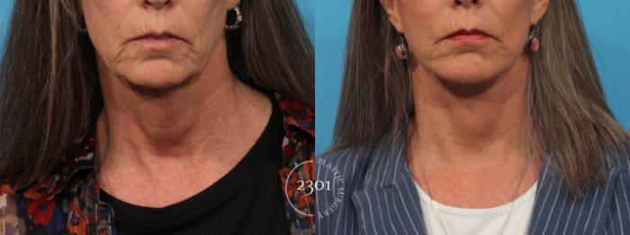 Before & After Face Lift Case 823 Front View in Fort Worth, Plano, & Frisco, Texas