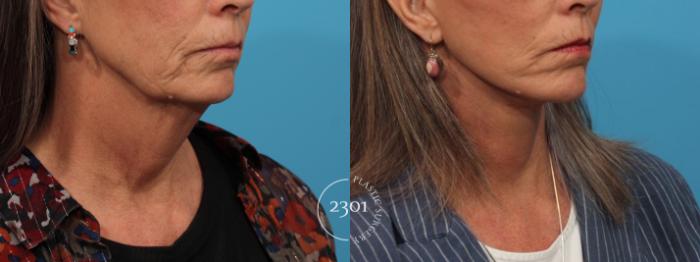 Before & After Face Lift Case 823 Right Oblique View in Fort Worth, Plano, & Frisco, Texas