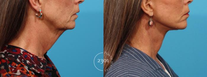 Before & After Face Lift Case 823 Right Side View in Fort Worth, Plano, & Frisco, Texas