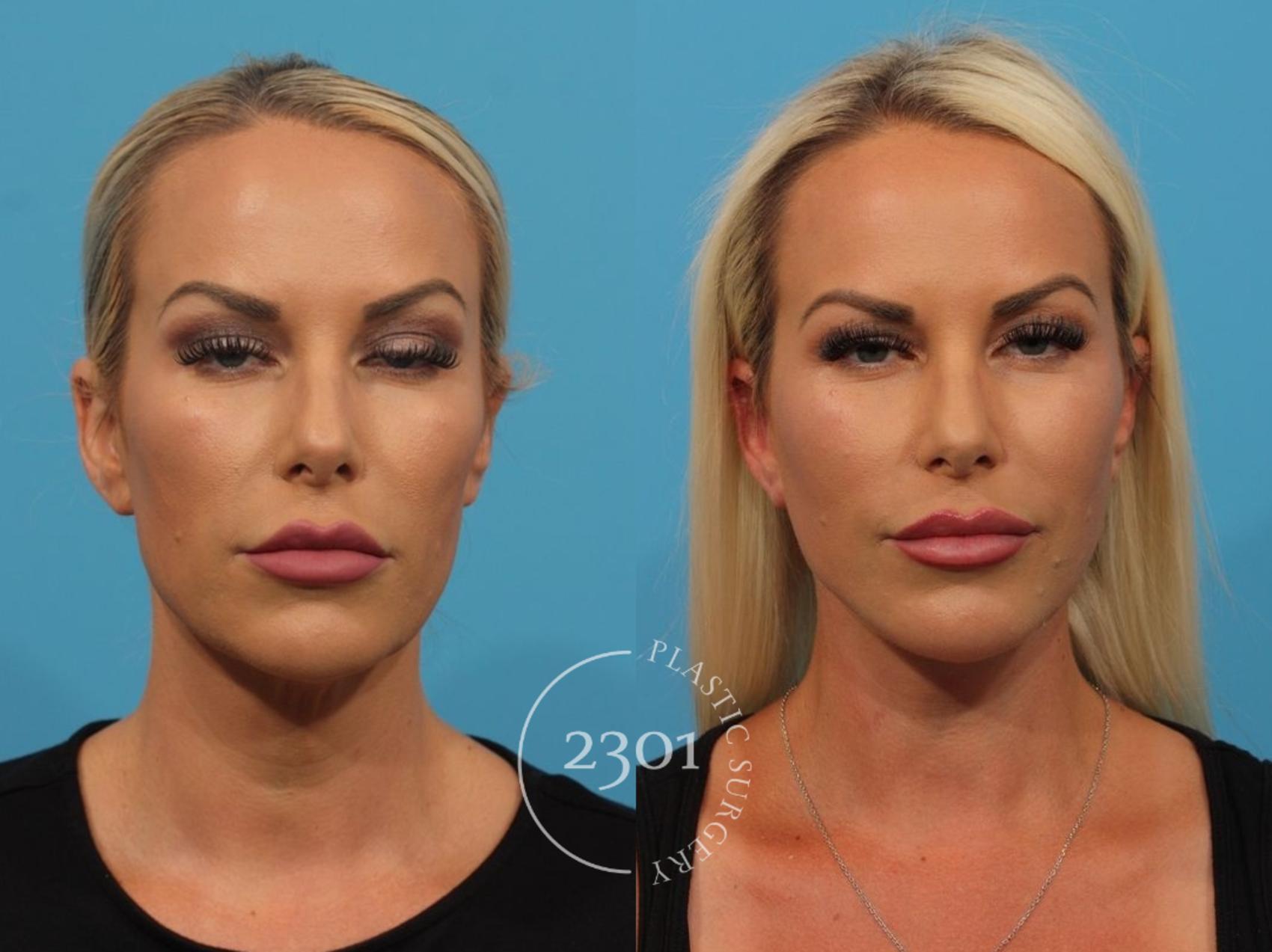 Before & After Facial Fat Grafting Case 824 Front View in Fort Worth, Plano, & Frisco, Texas