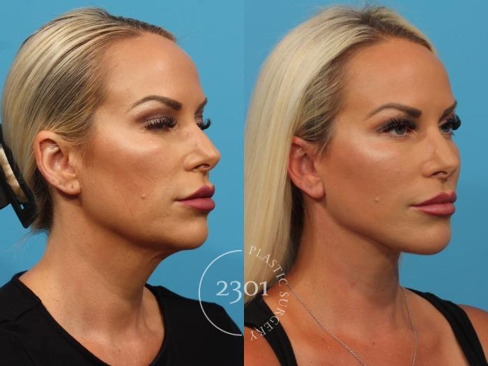 Before & After Face Lift Case 824 Right Oblique View in Fort Worth, Plano, & Frisco, Texas