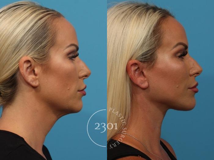 Before & After Face Lift Case 824 Right Side View in Fort Worth, Plano, & Frisco, Texas