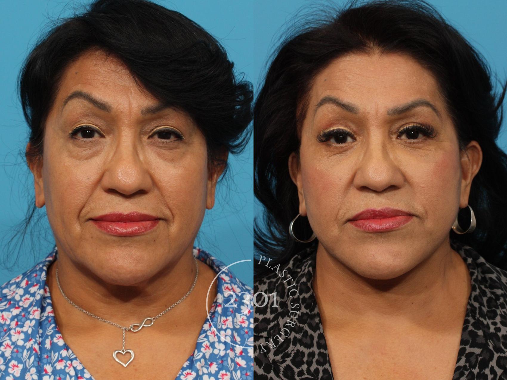 Before & After Neck Lift Case 841 Front View in Fort Worth, Plano, & Frisco, Texas