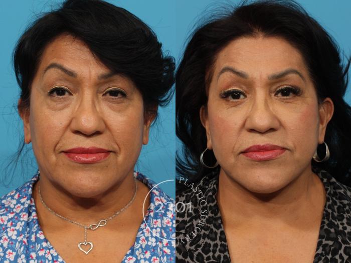 Before & After Neck Lift Case 841 Front View in Fort Worth, Plano, & Frisco, Texas