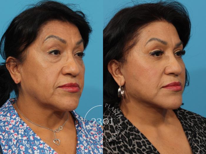 Before & After Neck Lift Case 841 Right Oblique View in Fort Worth, Plano, & Frisco, Texas