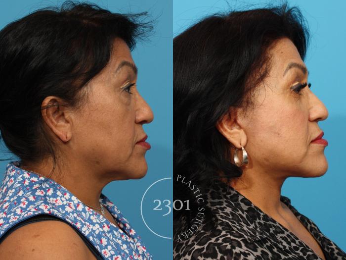 Before & After Neck Lift Case 841 Right Side View in Fort Worth, Plano, & Frisco, Texas