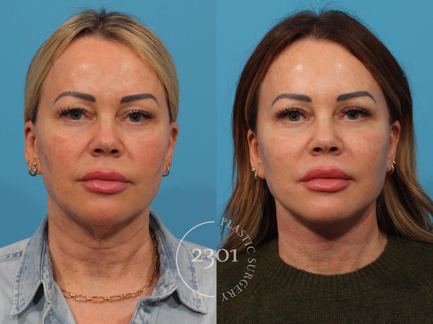 Before & After Face Lift Case 844 Front View in Fort Worth, Plano, & Frisco, Texas