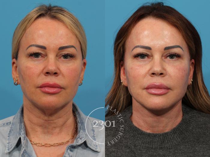 Before & After Neck Lift Case 844 Front View in Fort Worth, Plano, & Frisco, Texas