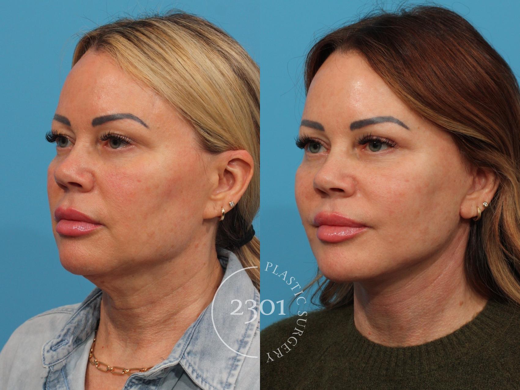 Before & After Face Lift Case 844 Left Oblique View in Fort Worth, Plano, & Frisco, Texas