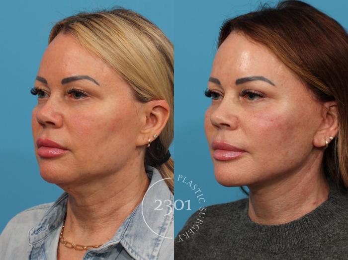 Before & After Face Lift Case 844 Left Oblique View in Fort Worth, Plano, & Frisco, Texas