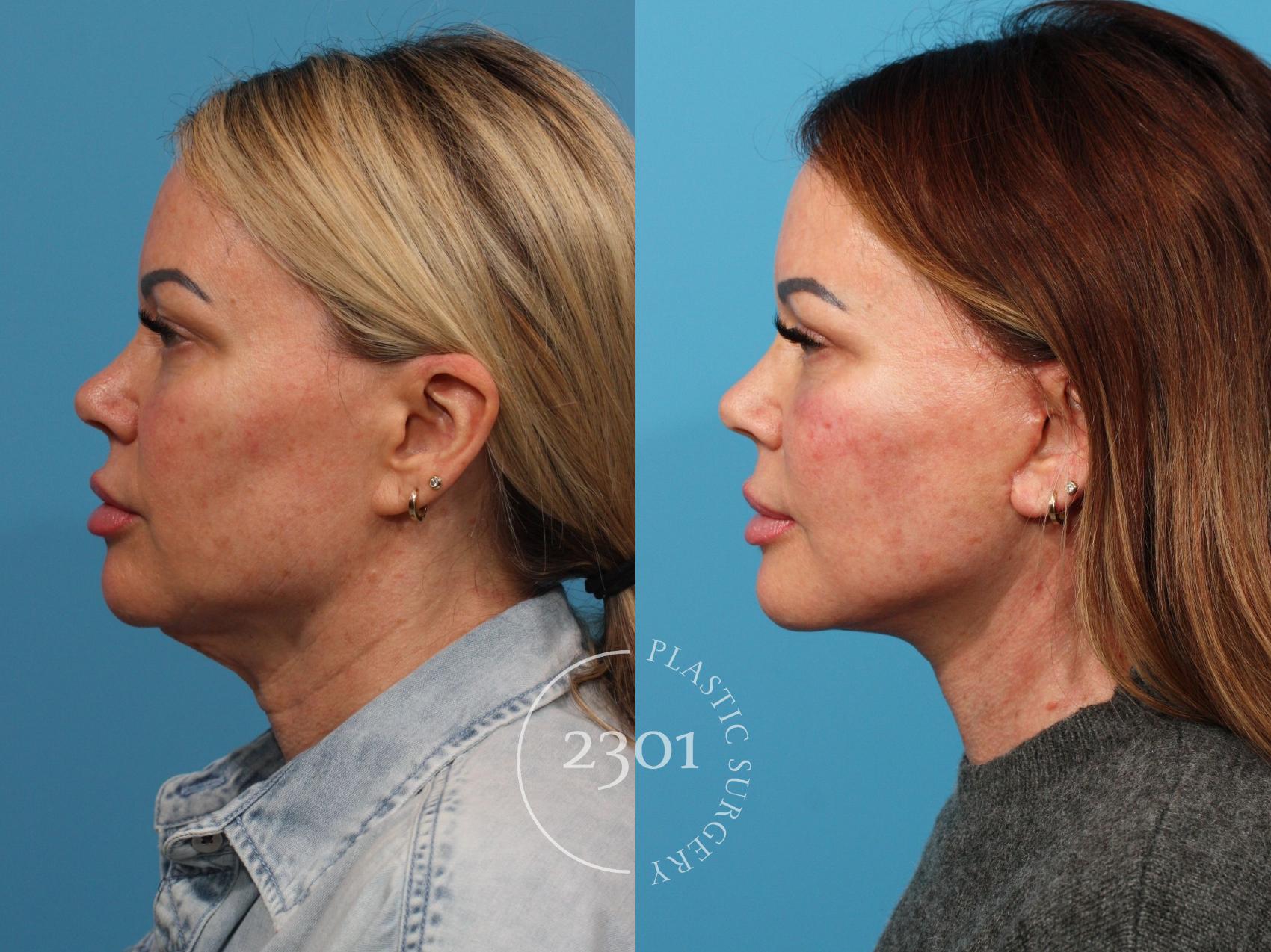 Before & After Neck Lift Case 844 Left Side View in Fort Worth, Plano, & Frisco, Texas