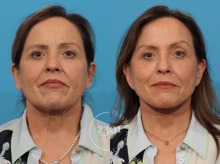 Before & After Face Lift Case 860 Front View in Fort Worth, Plano, & Frisco, Texas