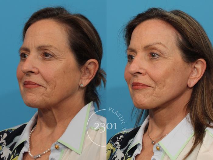 Before & After Face Lift Case 860 Left Oblique View in Fort Worth, Plano, & Frisco, Texas