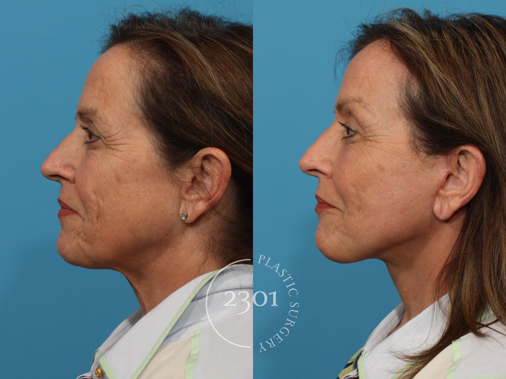 Before & After Face Lift Case 860 Left Side View in Fort Worth, Plano, & Frisco, Texas