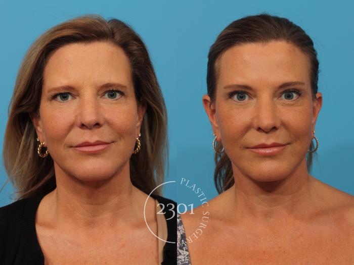 Before & After Face Lift Case 878 Front View in Fort Worth, Plano, & Frisco, Texas